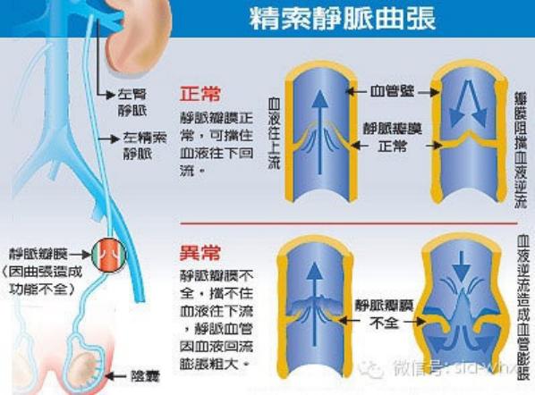 關于2021年征兵精索靜脈曲張標準的探討，2021年征兵精索靜脈曲張標準深度解析