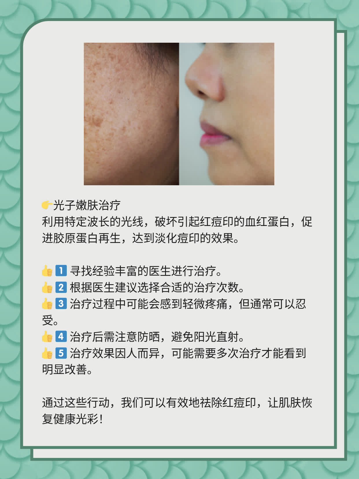 如何有效去除紅痘印，一站式解決方案，一站式解決紅痘印問題，有效去除方法大全